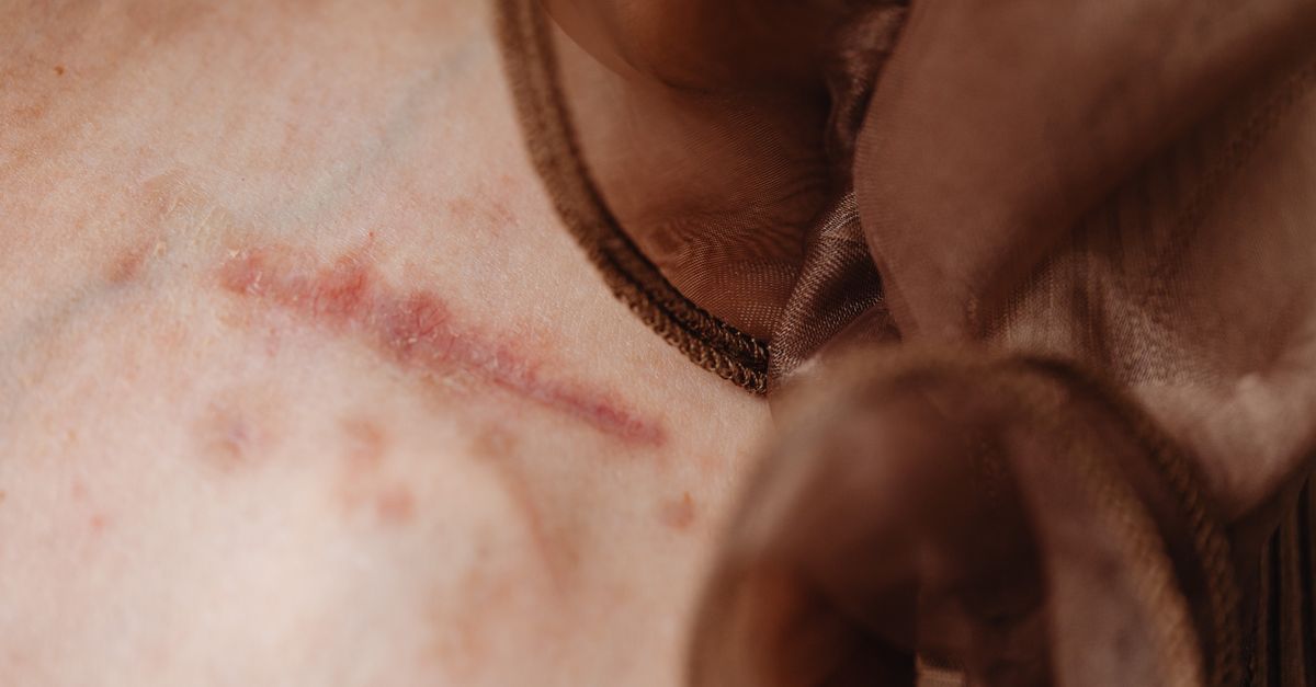 Detailed close-up of human skin revealing a surgical scar, skin texture, and fabric detail.