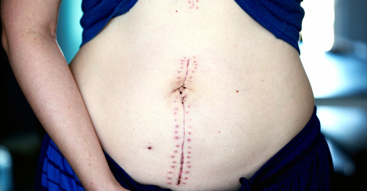 Close-up image showing a healing scar on a woman's abdomen post-surgery.
