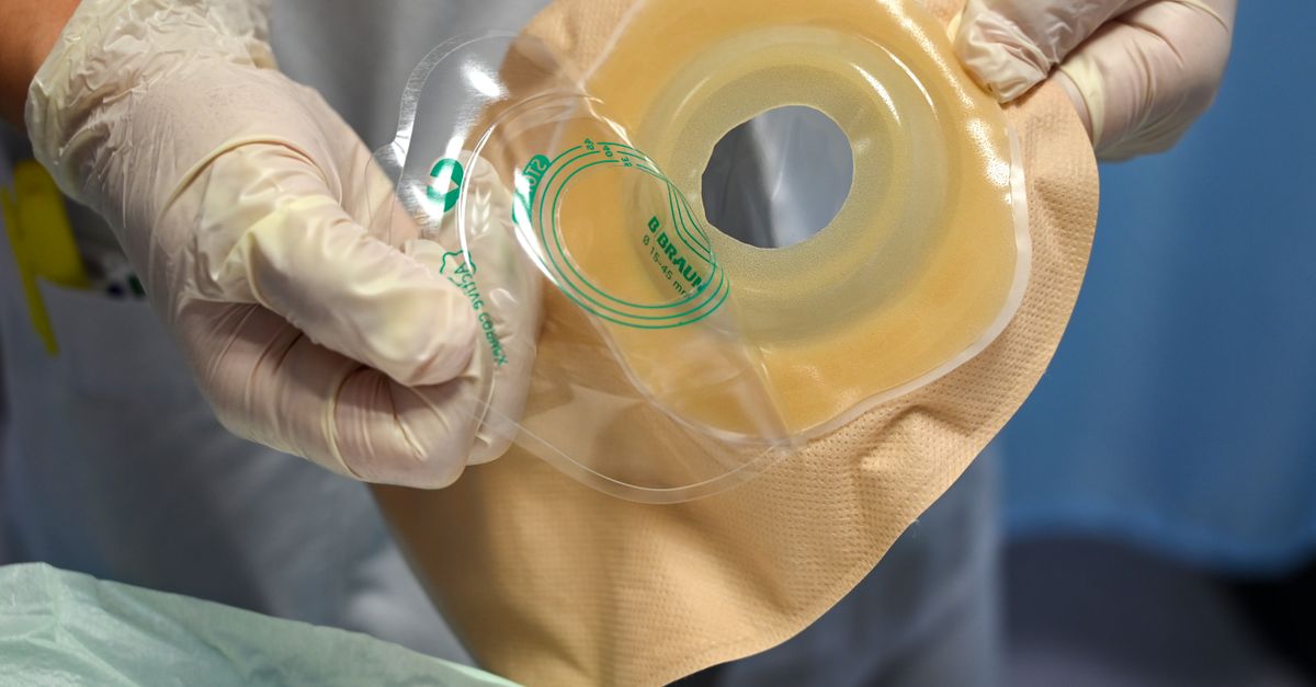 Nurse preparing ostomy pouch for patient care in a clinical environment.