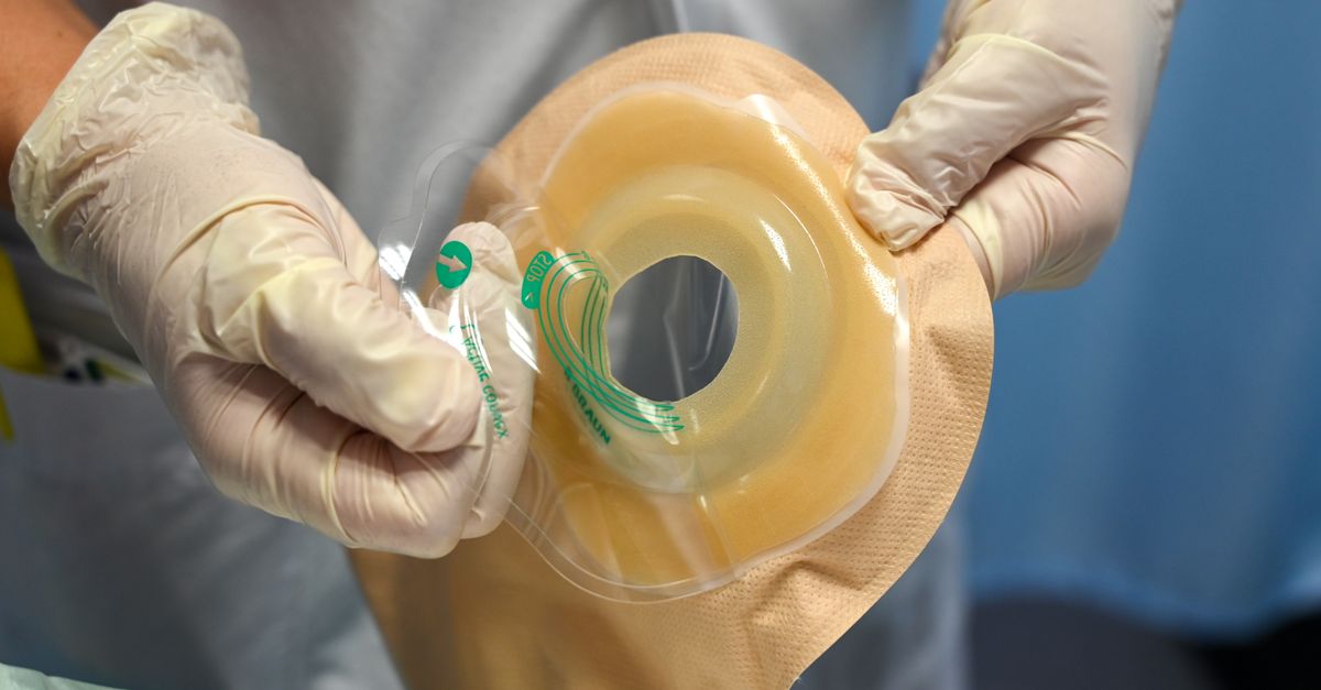 Close-up of a nurse wearing gloves while handling an ostomy pouch in a clinical environment.