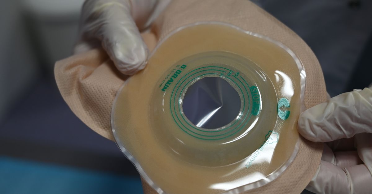 Close-up of a healthcare professional holding an ostomy bag with gloves in a medical setting.